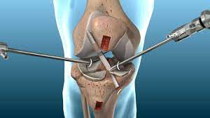 ACL Reconstruction in India: Treatment, Complications, and Outcomes - Trends We